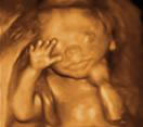 Gestation 17-20 Weeks