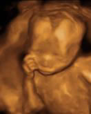 Gestation 17-20 Weeks