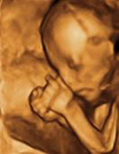 Gestation 17-20 Weeks