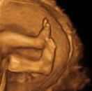 Gestation 21-24 Weeks