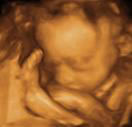 Gestation 21-24 Weeks