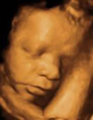 Gestation 29-32 Weeks
