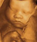 Gestation 29-32 Weeks
