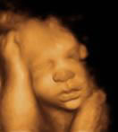 Gestation 33-36 Weeks