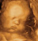 Gestation 33-36 Weeks