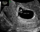 Gestation 5th Week