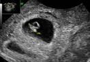 Gestation 6th Week