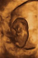 Gestation 8-12 Weeks