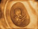Gestation 8-12 Weeks